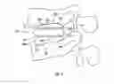 Fig. 10 - Expandable fusion device and method of installation thereof