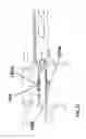 Fig. 25 - Insertion tool for implant and methods of use