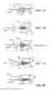 Fig. 02 - Methods and apparatus for intervertebral disc prosthesis insertion