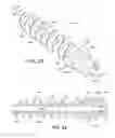 Fig. 19 - Device and method for fixation for bone or soft tissue deformity of digits