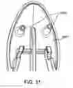 Fig. 35 - Devices and methods for pelvic organ prolapse alleviation