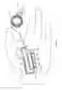 Fig. 06 - Occlusion sensing for an infusion pump