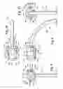Fig. 05 - Ventilator to tracheotomy tube coupling
