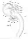 Fig. 08 - Ventilator to tracheotomy tube coupling
