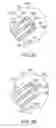 Fig. 08 - Methods, medical devices and kits for modifying the luminal profile of a body vessel