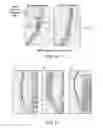 Fig. 14 - Methods, medical devices and kits for modifying the luminal profile of a body vessel