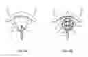 Fig. 12 - Methods and systems for treatment of a bladder