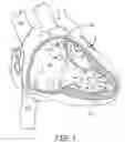 Fig. 02 - Interventional medical systems, catheters, and subassemblies