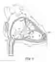 Fig. 03 - Interventional medical systems, catheters, and subassemblies
