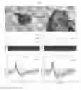 Fig. 18 - METHODS AND ASSOCIATED NEURAL PROSTHETIC DEVICES FOR BRIDGING BRAIN AREAS TO IMPROVE FUNCTION