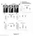 Fig. 26 - Small interfering RNA (siRNA) for the therapy of type 2 (ADO2) autosomal dominant osteopetrosis caused by CLCN7 (ADO2 CLCN7-dependent) gene mutation