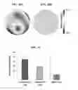 Fig. 15 - Customized wavefront-guided methods, systems, and devices to correct higher-order aberration