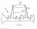 Fig. 04 - CLEAVAGE ENHANCEMENT BRA
