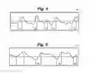 Fig. 05 - Method for assessment of cerebrovascular regulation