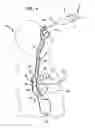 Fig. 07 - Systems, devices, components and methods for displacing and repositioning the esophagus away from the heart during atrial ablation surgical procedures