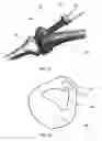 Fig. 08 - Guide sleeve for suprapatellar surgery