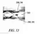 Fig. 10 - Clot retrieval system