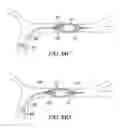 Fig. 48 - Clot retrieval system