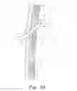 Fig. 06 - CHEST TUBE INSERTION GUIDE AND METHOD OF USING THE SAME
