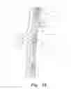 Fig. 07 - CHEST TUBE INSERTION GUIDE AND METHOD OF USING THE SAME