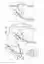 Fig. 04 - Fossa ovalis penetration