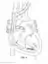 Fig. 09 - LEAD EXTRACTION