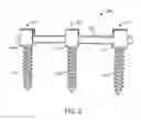 Fig. 04 - Spinal rod implant extension