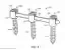 Fig. 05 - Spinal rod implant extension