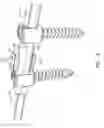 Fig. 16 - Spinal rod implant extension