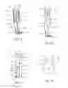 Fig. 18 - Method and apparatus for performing spinal surgery