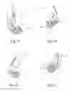 Fig. 31 - Method and apparatus for performing spinal surgery