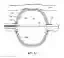 Fig. 11 - Temperature and strain measurement technique during cryoablation