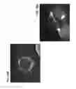 Fig. 20 - CATHETER DEVICE INCLUDING FLOW SENSING