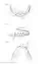 Fig. 02 - Stents for placement of orthodontic attachments, and methods of producing and using such stents