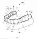 Fig. 03 - Detachable orthodontic bracket and wire system