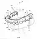 Fig. 05 - Detachable orthodontic bracket and wire system