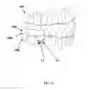 Fig. 32 - Detachable orthodontic bracket and wire system