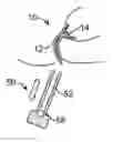 Fig. 01 - Fecal incontinence device for positioning in the lower rectum