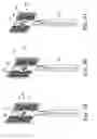 Fig. 14 - Pelvic implant and treatment method