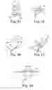 Fig. 17 - Pelvic implant and treatment method