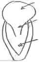 Fig. 01 - Device and method for reducing cardiac valve regurgitation