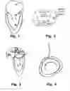 Fig. 02 - Device and method for reducing cardiac valve regurgitation