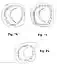 Fig. 04 - Device and method for reducing cardiac valve regurgitation