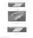 Fig. 02 - Surgically implantable knee prosthesis with captured keel