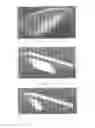 Fig. 03 - Surgically implantable knee prosthesis with captured keel