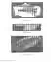 Fig. 08 - Surgically implantable knee prosthesis with captured keel