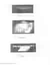 Fig. 22 - Surgically implantable knee prosthesis with captured keel