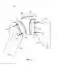 Fig. 05 - Stemless shoulder implant