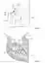 Fig. 08 - Stemless shoulder implant
