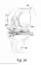 Fig. 14 - Surgical instruments for preparing a patient's tibia to receive an implant